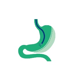 Endoskopische Magenverkleinerung (ESG)
