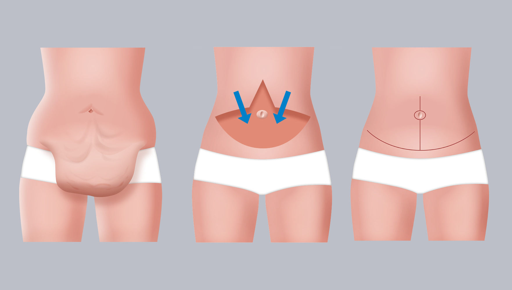Infografik: Bauchdeckenstraffung (Abdominoplastik) Ankerschnitt