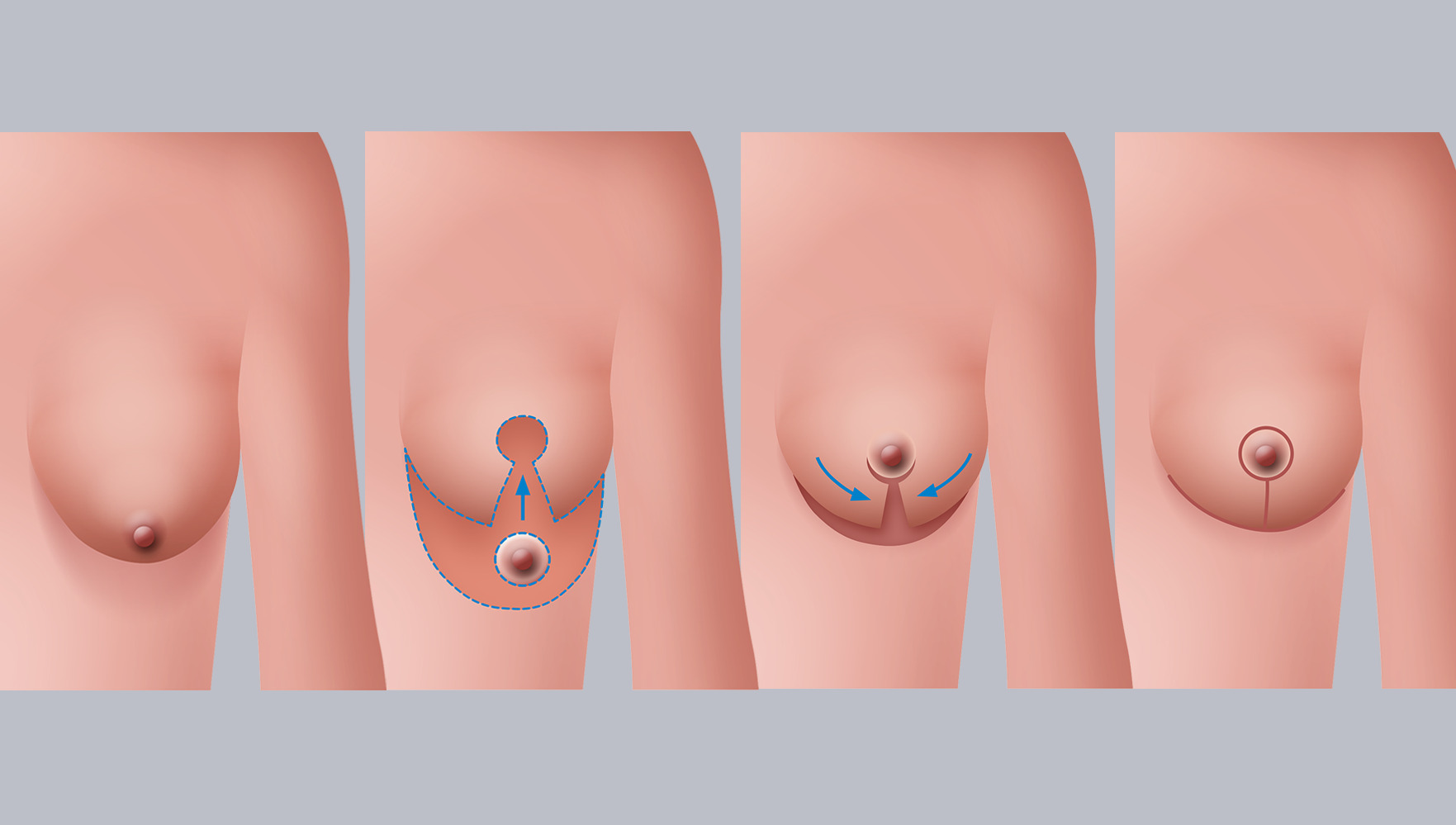 Infografik: Bruststraffung