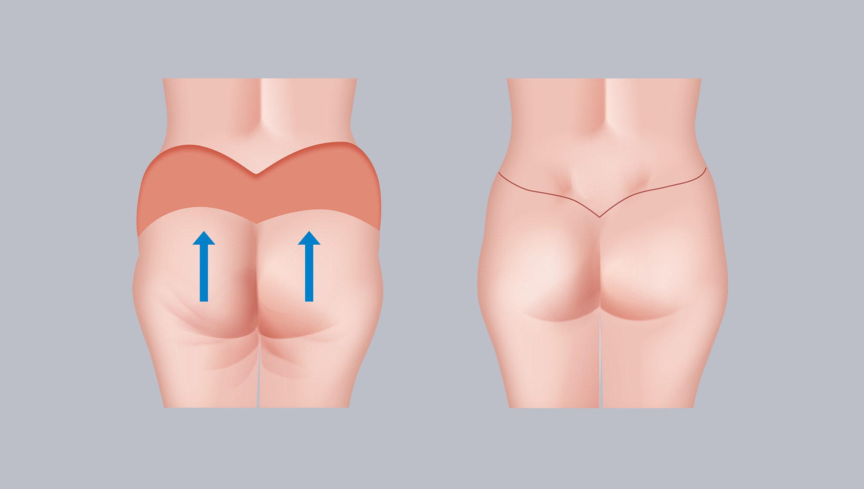 Infografik: Gesäßstraffung