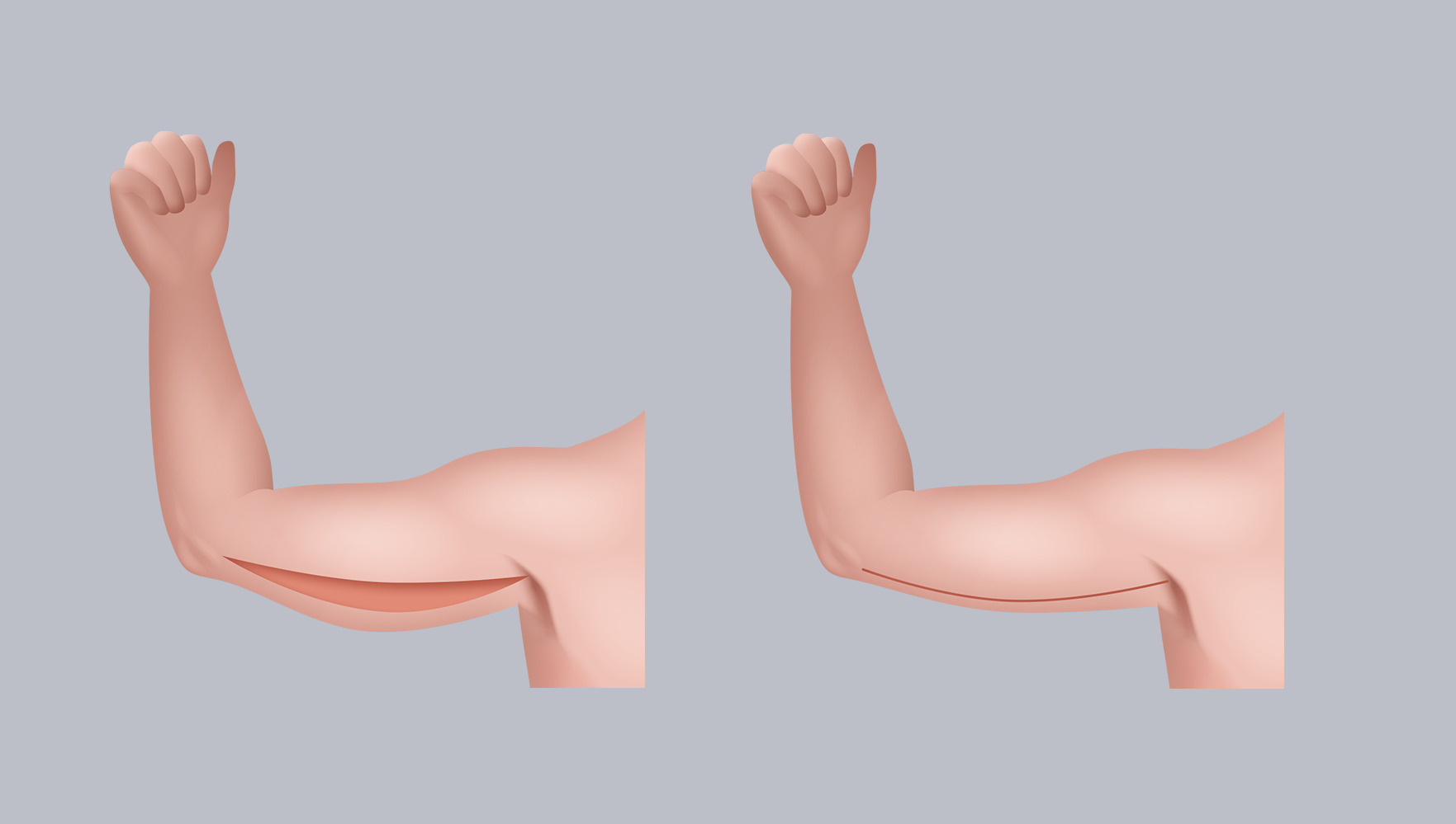 Infografik: Oberarmstraffung