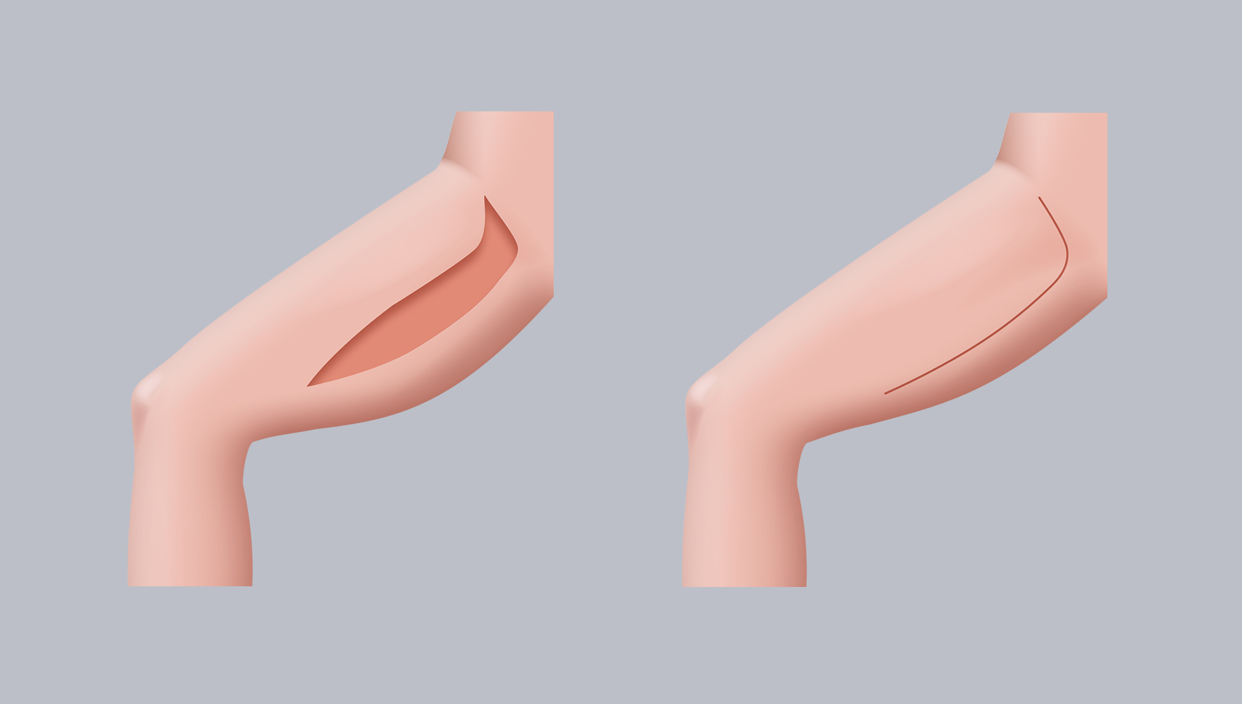 Infografik: Oberschenkelstraffung